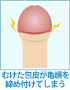 カントン包茎