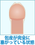 仮性包茎